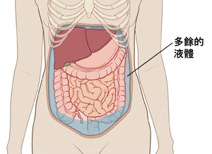 女性腹部轮廓图，显示腹部器官。液体注入腹腔器官周围。 