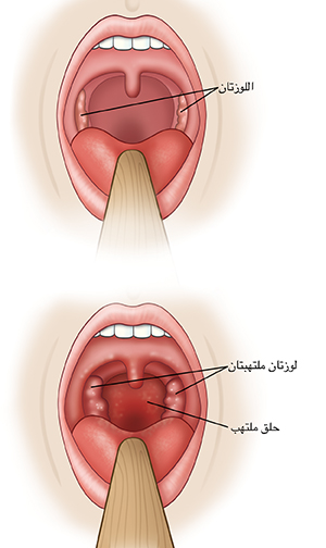 منظر مقرب للحلق يبين اللوزتين في حالة طبيعية ومنظر آخر يبين اللوزتين والحلق في حالة التهاب.