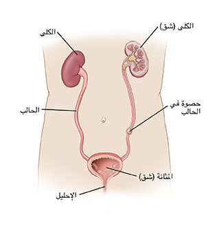 شكل توضيحي يظهر تشريح الجهاز البولي بما في الكلى والمثانة ومجرى البول وحصوة في الحالب.