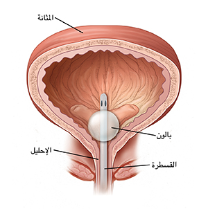 مقطع عرضي للمثانة يوضح مكان القسطرة.