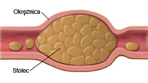 okrężnica, stolec