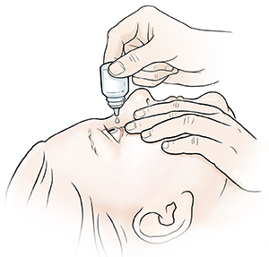 Person leaning head back and pulling gently down on lower eyelid while other hand is squeezing eye drops into eye.