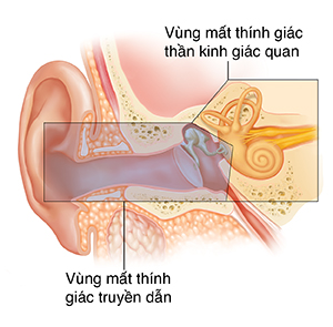 Mặt cắt ngang của tai cho thấy cấu trúc tai ngoài, trong và giữa. Lớp phủ màu cho thấy các khu vực gây mất thính lực dẫn truyền và thần kinh giác quan.
