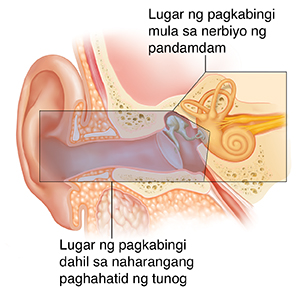 Cross section ng tainga na ipinakikita ang panlabas, panloob, at gitnang istruktura ng tainga. Nilagyan ng kulay para maipakita ang mga bahagi na nagiging sanhi ng conductive at sensorineural na pagkawala ng pandinig.