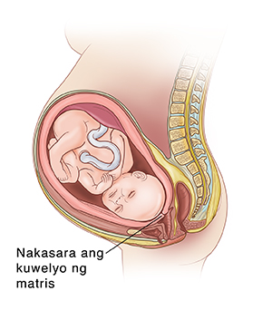 Gilid na kuha ng sanggol sa matris na ipinakikita ang makapal na kuwelyo ng matris at nakasara.