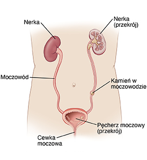 Ilustracja przedstawiająca anatomię układu moczowego, w tym nerki, pęcherz moczowy, cewkę moczową oraz kamień w moczowodzie.