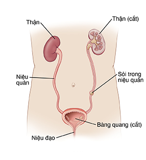 Hình minh họa thể hiện giải phẫu của hệ tiết niệu, bao gồm thận, bàng quang, niệu đạo và sỏi trong niệu quản.