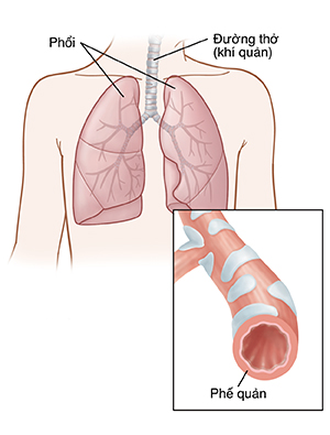 Mặt trước ngực của trẻ hiển thị phổi. Hình nhỏ hiển thị mặt cắt của phế quản.