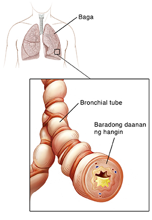 Balangkas ng dibdib ng tao na nakikita ang lalagukan at mga baga. Malapitang kuha ng bronchial tube na ipinakikita ang pamamaga at naiipong uhog.