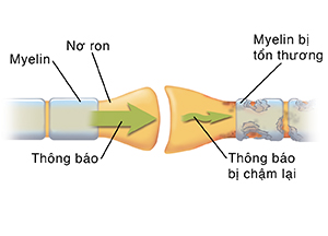 Cận cảnh khớp thần kinh nơi hai tế bào thần kinh gặp nhau. Các mũi tên hiển thị thông báo di chuyển qua tế bào thần kinh khỏe mạnh và bị gián đoạn trong tế bào thần kinh bị tổn thương.
