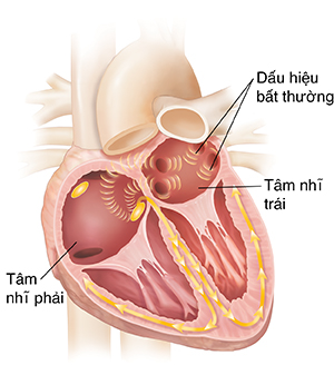Mặt cắt ngang của tim cho thấy rung nhĩ.