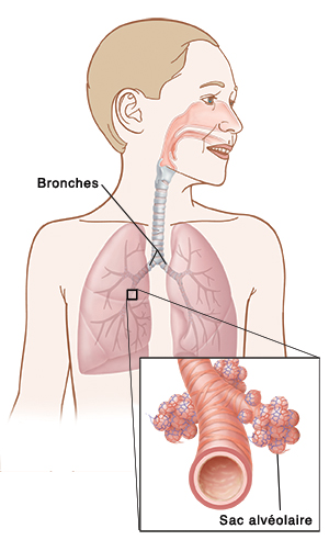 Illustration montrant la position des poumons et des tubes bronchiques, avec une image rapprochée d'un sac alvéolaire.