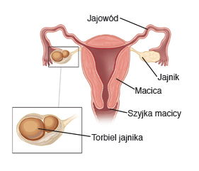 Rysunek pokazujący przekrój macicy z jajowodami, szyjką macicy, jajnikami i torbielą jajnika.