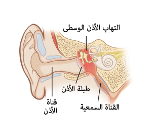 صورة توضح مقطعًا عرضيًا من الأذن، بما يشمل قناة الأذن، وطبلة الأذن، والقناة السمعية، والأذن الوسطى الملتهبة.