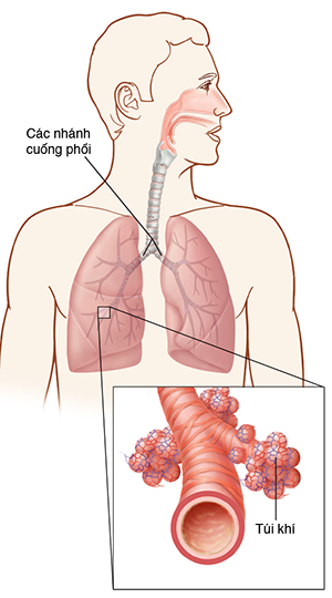 Hình minh hoạ cho thấy vị trí của phổi và các phế quản, với hình nhìn gần của một túi không khí.