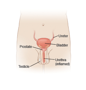Imagen de las vías urinarias masculinas, en la que se ve la ubicación de la vejiga, el uréter, la próstata, la uretra y los testículos.