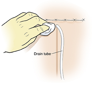 Cận cảnh bàn tay đeo găng đang vệ sinh da quanh ống thoát dịch gần vết rạch phẫu thuật.