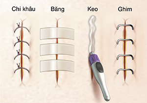 Hình ảnh mũi khâu, dải khử trùng, keo và ghim khép miệng viết thương.