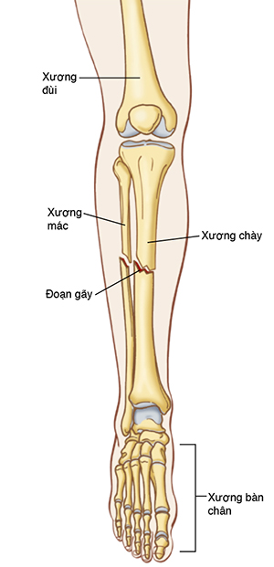 Hình minh hoạ cho thấy đường nét và xương của cẳng chân phần dưới, bao gồm xương đùi và xương bàn chân, và cho thấy chỗ bị gãy ở xương mác và xương ống chân.