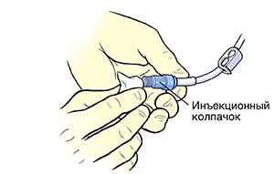 Крупный план рук, очищающих инъекционный колпачок центрального катетера спиртовой салфеткой.