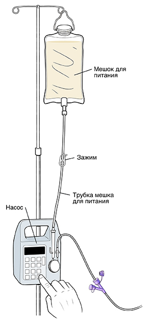 Мешок для питания свисает с опоры на помпе. Трубки мешка для питания ведут от мешка к помпе. В середине трубок есть зажим.