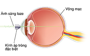 Hình ngang mắt cho thấy thủy tinh thể ở phía trước mắt. Ánh sáng laze đang tập trung vào bờ sau bên trong của mắt.