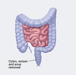 Front view of intestines with the colon, rectum, and anus highlighted showing section to be removed.