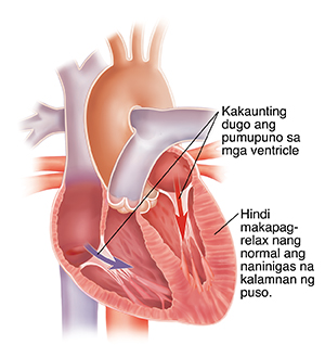Cross section ng puso dahil sa pagpalya nito sanhi ng paninigas at pagkapuno ng kalamnan ng puso.