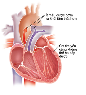 Mặt cắt ngang của tim giãn với suy tim tâm thu.