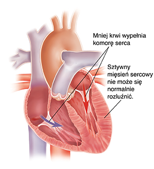 Przekrój serca przy rozkurczowej niewydolności serca.