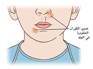 صورة مقرّبة لأسفل الوجه والرقبة. تقرحات عدوى المكورات العنقودية على الأنف وبالقرب من الفم.