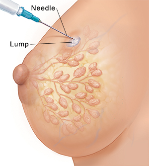 帶有管道與小葉的女性乳腺側視圖,顯示腫塊穿刺活檢。
