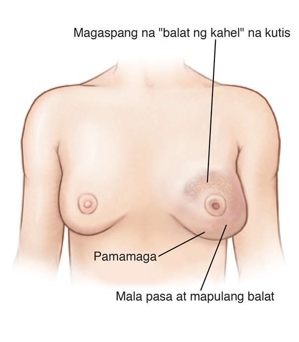 Harapang tanaw na makikita ang namamagang dibdib ng babae, balat na magaspang na tila balat ng kahel, at mukhang may pasa at mamula-mula ang balat sa kaliwang suso. May baliktad na utong ang kaliwang suso. Normal ang kanang suso.